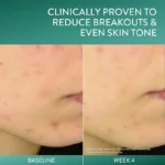 Cetaphil Gentle Clear Triple-Action Acne Treatment Serum – 30ml - Image 3